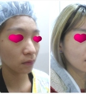 명품코성형(고어텍스+귀연골+비중격연골+인공뼈)