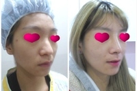 명품코성형(고어텍스+귀연골+비중격연골+인공뼈)