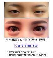완전절개.눈매교정.앞트임