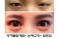 완전절개.눈매교정.앞트임