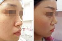 비중격연골을 이용한 융비술