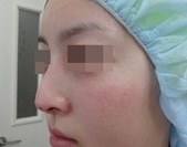 비중격연골을 이용한 융비술