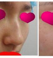 명품코성형(실리콘+귀연골+비중격연골)
