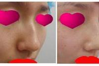 명품코성형(실리콘+귀연골+비중격연골)