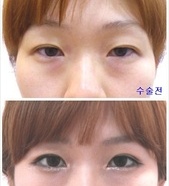 비절개눈매교정