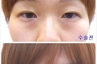비절개눈매교정